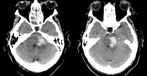 pontine infarction icd 10|ischemic stroke icd 10.